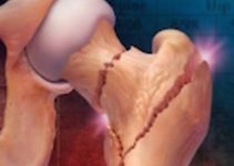 Ізраїльськими ученими розроблений абсолютно новий спосіб терапії остеопорозу