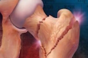 Ізраїльськими ученими розроблений абсолютно новий спосіб терапії остеопорозу