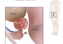 Хірургія простати: діагноз раку — не вирок Хірургія простати: діагноз раку — не вирок