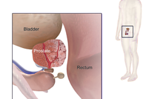 Хірургія простати: діагноз раку — не вирок