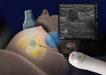 Як лікують рак грудей в Ізраїлі