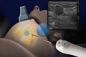 Як лікують рак грудей в Ізраїлі