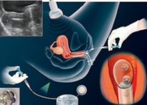 Методика ізраїльських фахівців вдвічі збільшує успішність проведення штучного запліднення