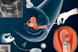 Методика ізраїльських фахівців вдвічі збільшує успішність проведення штучного запліднення