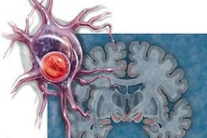 Нейродегеративні захворювання та їх причини