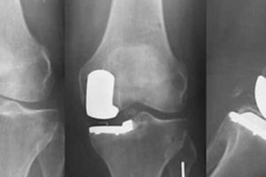 Нова методика ендопротезування