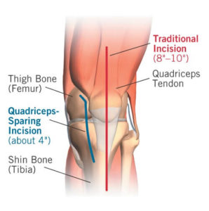 Артропластика суглоба стегна або коліна зайняла лідируючі позиції в ендопротезуванні.