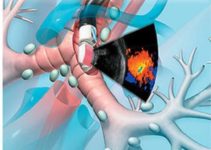 Нова програма діагностики раку без операції — Endobronchial ultrasound (EBUS)