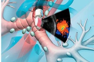 Нова програма діагностики раку без операції — Endobronchial ultrasound (EBUS)