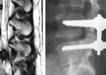 Нове відкриття спінальної хірургії Нове відкриття спінальної хірургії