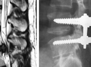 Нове відкриття спінальної хірургії