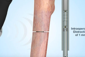 Новинка дитячої ортопедії — модуль Precice Nail для подовження нижніх кінцівок без спиць