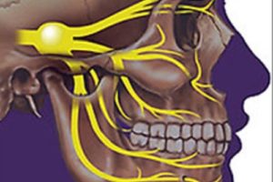 Переважний метод лікування невралгії трійчастого нерва