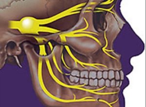 Переважний метод лікування невралгії трійчастого нерва