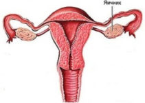 Превентивне видалення яєчників — думка фахівців