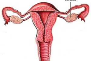 Превентивне видалення яєчників — думка фахівців
