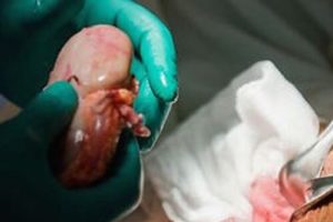 Прогресивна методика пересадки органів