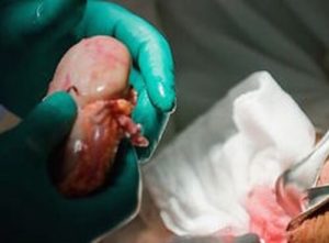 Прогресивна методика пересадки органів