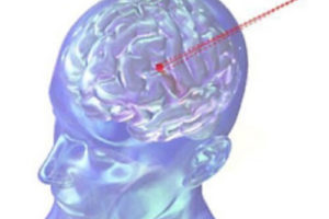 Променева терапія стала безпечніше