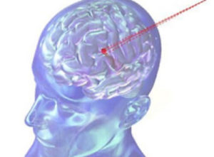 Променева терапія стала безпечніше