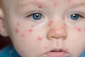 У дитини – вітряна віспа