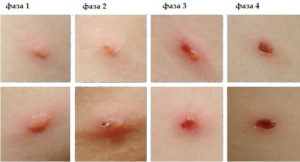 Шкірні висипання вітрянки у дітей