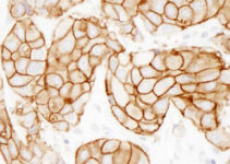 Відновлення серцевого м’яза після інфаркту Відновлення серцевого м’яза після інфаркту