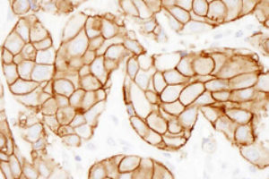 Відновлення серцевого м’яза після інфаркту